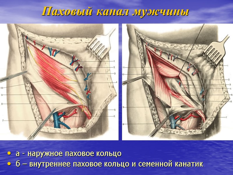 Паховый канал мужчины а - наружное паховое кольцо б – внутреннее паховое кольцо и